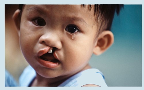 Dị tật sứt môi, hở hàm ếch ảnh hưởng như thế nào đến trẻ ?