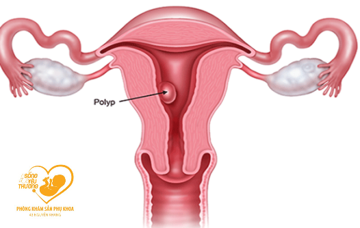 Nguyên nhân và yếu tố gây polyp tử cung và cách điều trị