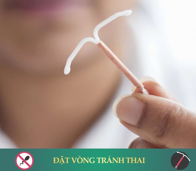 Đặt vòng tránh thai, phương pháp tránh thai hiện đại hiệu quả