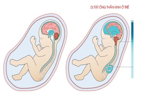 5 loại dị tật thai nhi mẹ bầu cần lưu ý