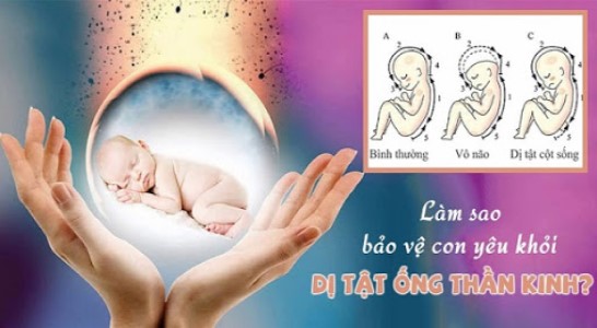 Dị tật ống thần kinh - dị tật bẩm sinh thường gặp