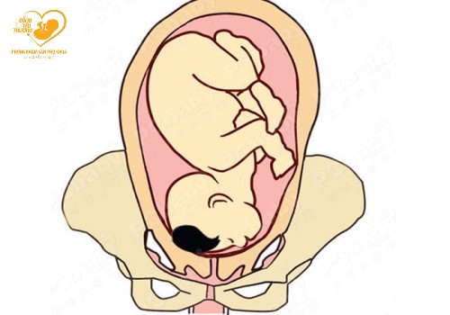 3 kiểu ngôi thai bất thường trong thai kỳ