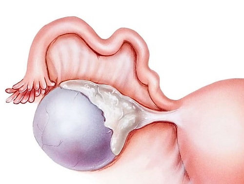 Nguyên nhân và đặc điểm của u nang bì buồng trứng