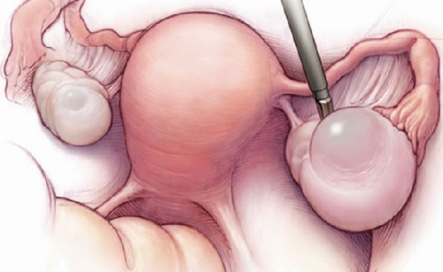 Triệu chứng thường gặp của u nang buồng trứng