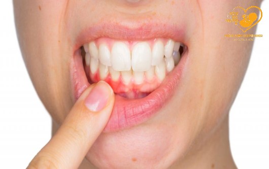 Những nguy cơ có thể gặp phải nếu mắc bệnh răng miệng khi mang thai