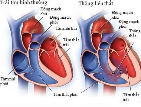 Bệnh thông liên thất có di truyền không?