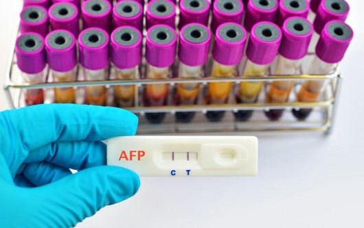 Xét nghiệm AFP (Alpha fetoprotein) và thai nghén