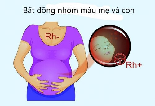 Mẹ mang nhóm máu Rh(-) âm cần lưu ý gì ?