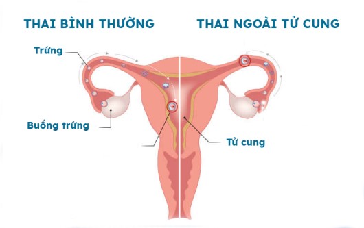 Giải đáp một số thắc mắc về thai ngoài tử cung