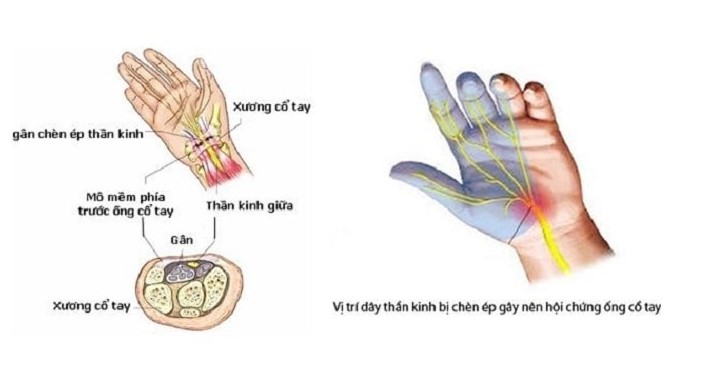 Hội chứng ống cổ tay khi mang thai