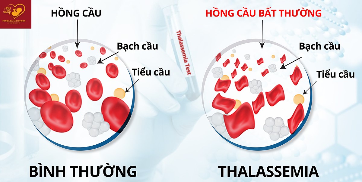 bệnh thalassemia