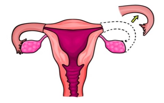 cắt vòi trứng, cắt ống dẫn trứng, vòi trứng, ống dẫn trứng, rụng trứng, ivf, hỗ trợ sinh sản, buồng trứng