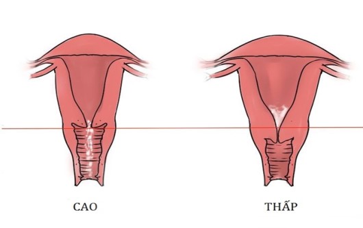 cổ tử cung cao, cổ tử cung, tử cung, thụ tinh