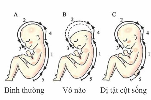 acid folic, dị tật