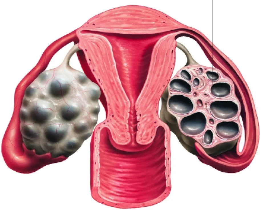 Hội chứng quá kích buồng trứng là một rủi ro IVF nguy hiểm
