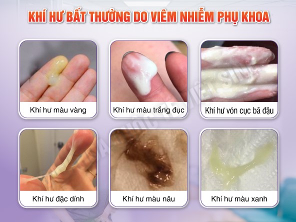 viêm phụ khoa ra khí hư bất thường