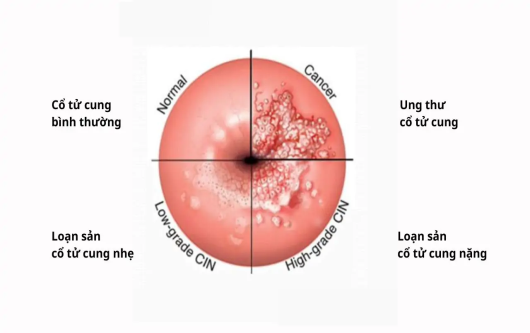 loạn sản cổ tử cung, ung thư cổ tử cung, cổ tử cung