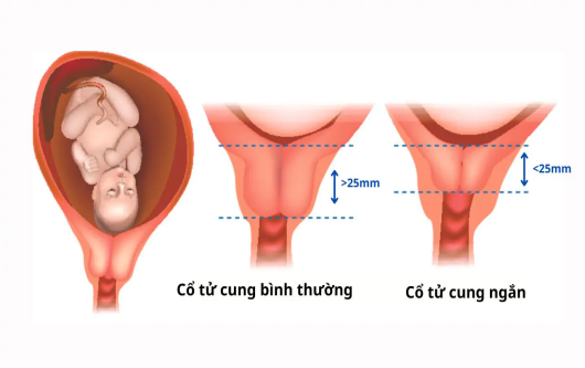 sinh non, chuyển dạ sinh non, vỡ màng ối, vỡ ối