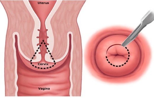 Khoét chóp cổ tử cung