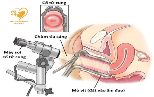 Soi cổ tử cung có đau không? quy trình soi cổ tử cung