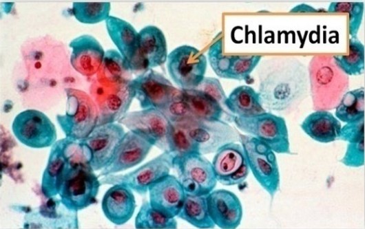 Tầm soát chlamydia trachomatis ở phụ nữ mang thai