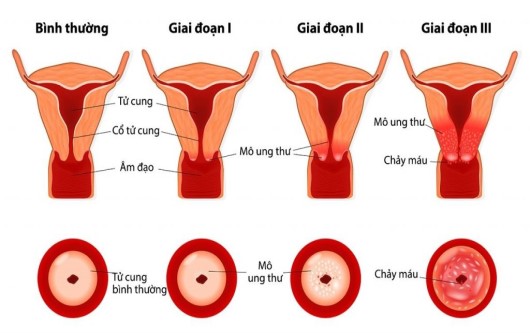 ung thư cổ tử cung, phòng tránh ung thư cổ tử cung, HPV, dự phòng ung thư cổ tử cung