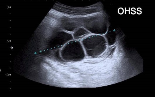 quá kích buồng trứng, kích trứng, kích thích buồng trứng, ivf, vô sinh