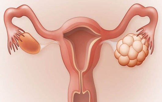 quá kích buồng trứng, kích trứng, kích thích buồng trứng, ivf, vô sinh