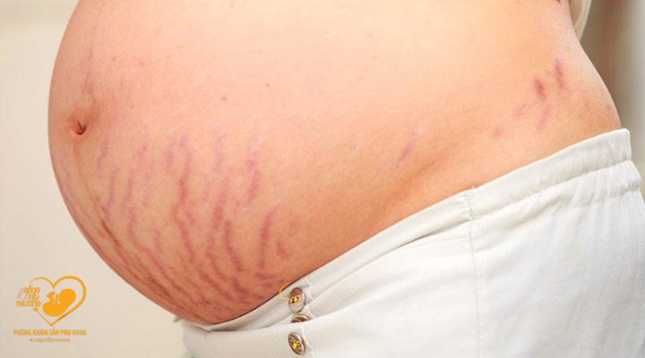 tình trạng rạn da rất phổ biến khi mang thai 
