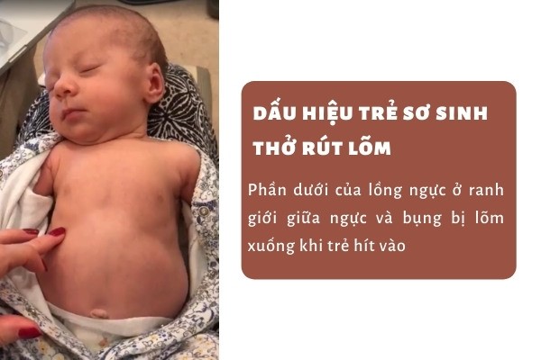 rút lõm lồng ngực