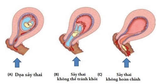 sẩy thai tự nhiên