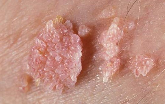 sùi mào gà, HPV, mụn cóc sinh dục, phụ nữ mang thai bị sùi mào gà