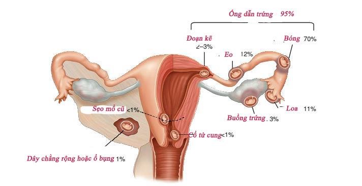 thai ngoài tử cung, chửa ngoài tử cung, phụ khoa