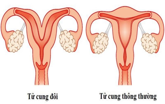 tử cung đôi, hai tử cung, tử cung kép, tử cung hai sừng, tử cung, tử cung vách ngăn