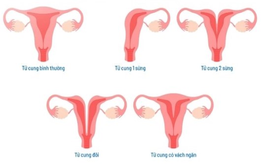 tử cung đôi, hai tử cung, tử cung kép, tử cung hai sừng, tử cung, tử cung vách ngăn