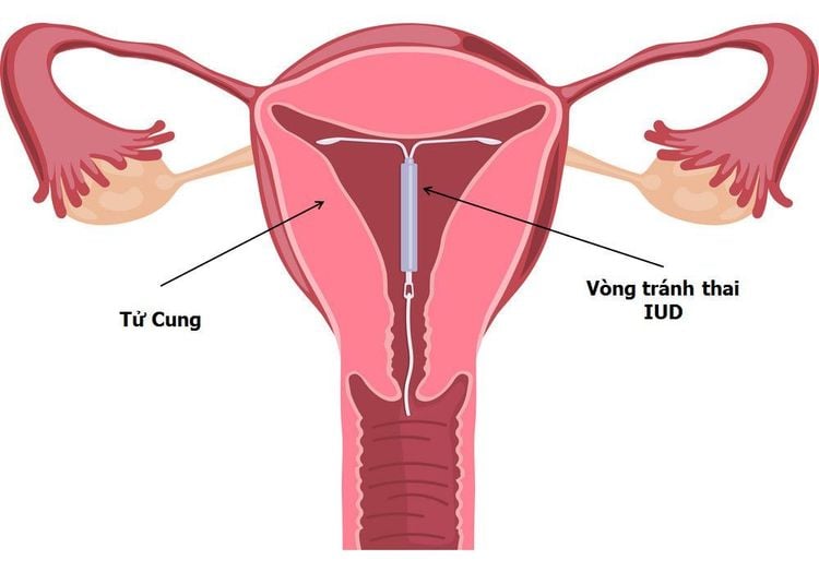 đặt vòng, đặt vòng tránh thai, mang thai