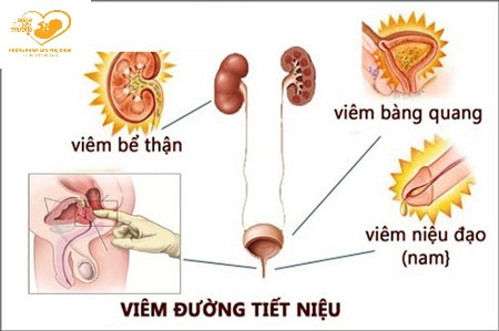 viêm tiết niệu