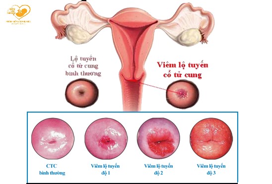 viêm lộ tuyến