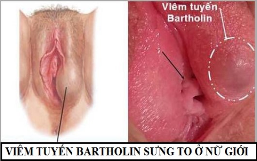 viêm tuyến bartholin có mang thai được không