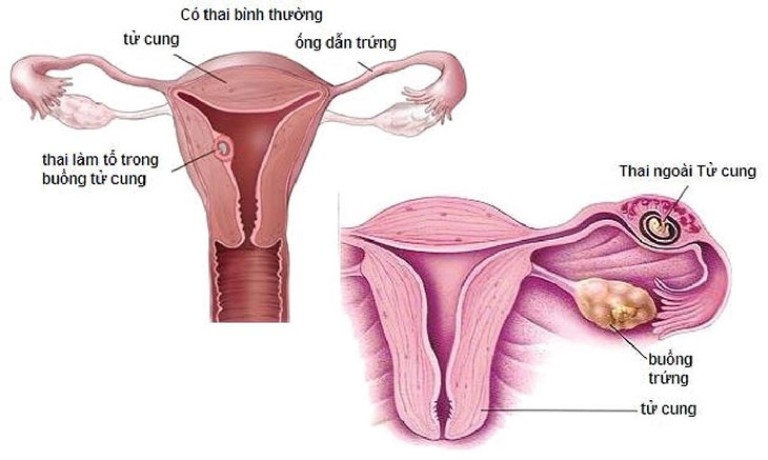 thai ngoài tử cung, chửa ngoài tử cung, viêm nhiễm phụ khoa