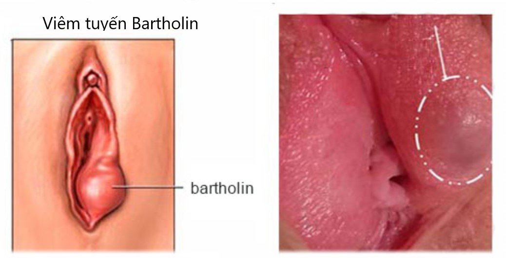 viêm tuyến bartholin