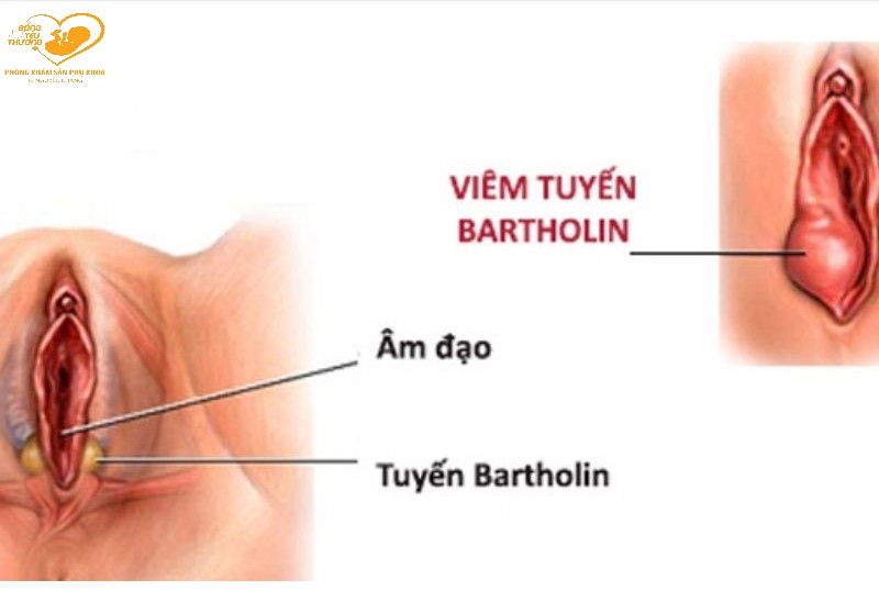 điều trị viêm tuyến bartholin