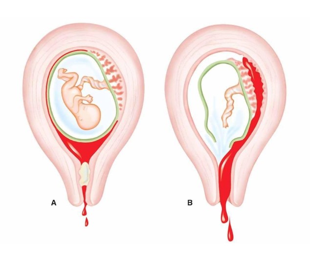 xuất huyết 3 tháng cuối thai kỳ